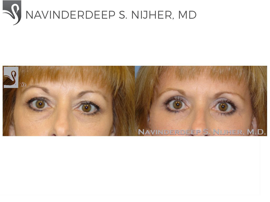 Before and After Image: Eyelid Surgery Case #8797 - front