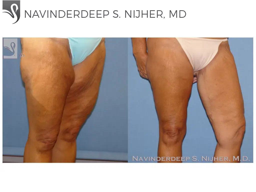 Before and After Image: Body Contouring Case #8797 - right-front-oblique