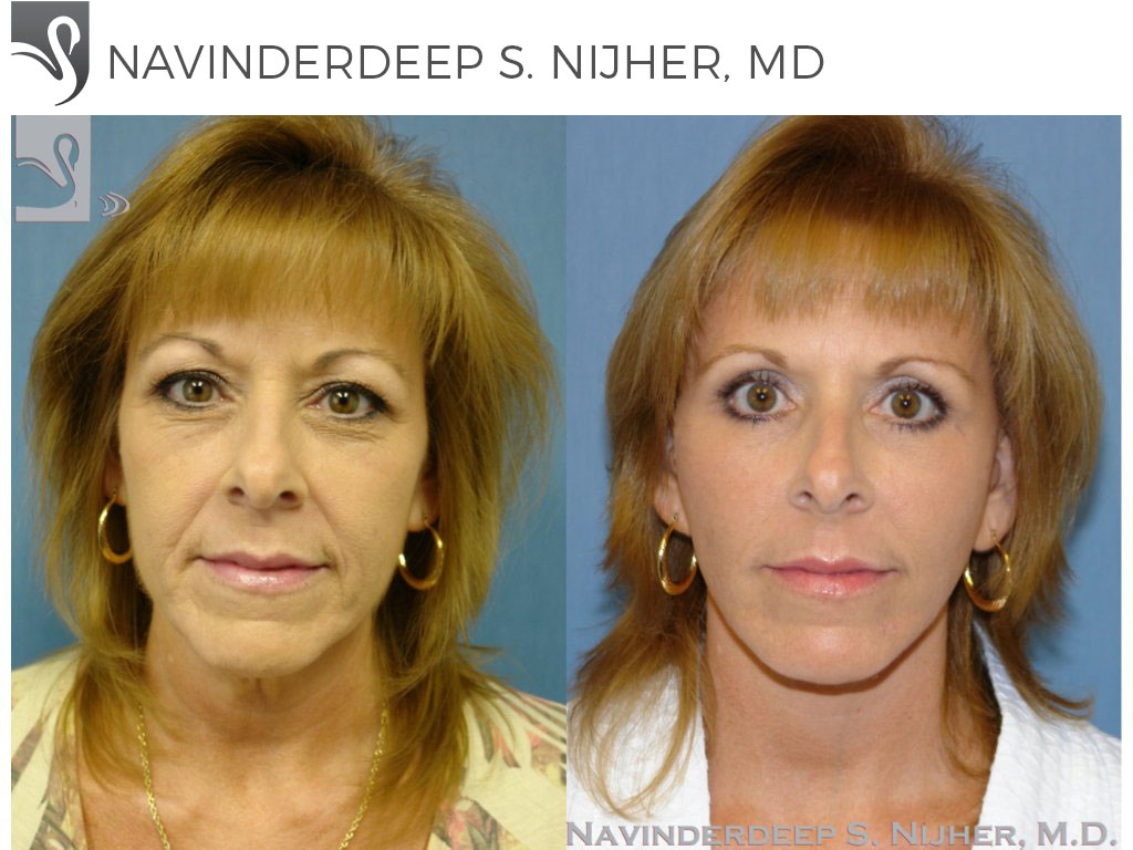 Before and After Image: Face Lift Case #8797 - front