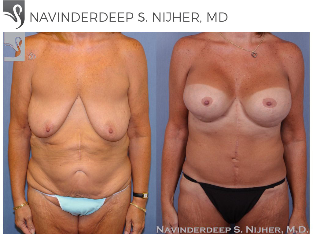 Before and After Image: Mommy Makeover Case #8797 - front