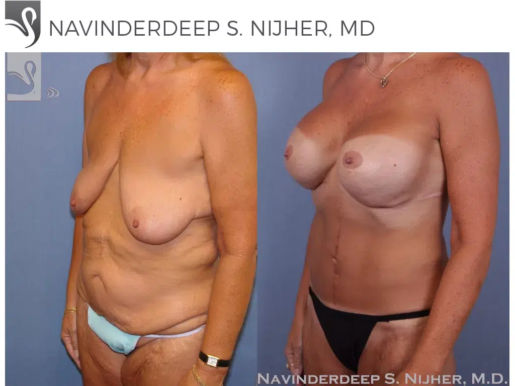 Before and After Image: Mommy Makeover Case #8797 - left-front-oblique