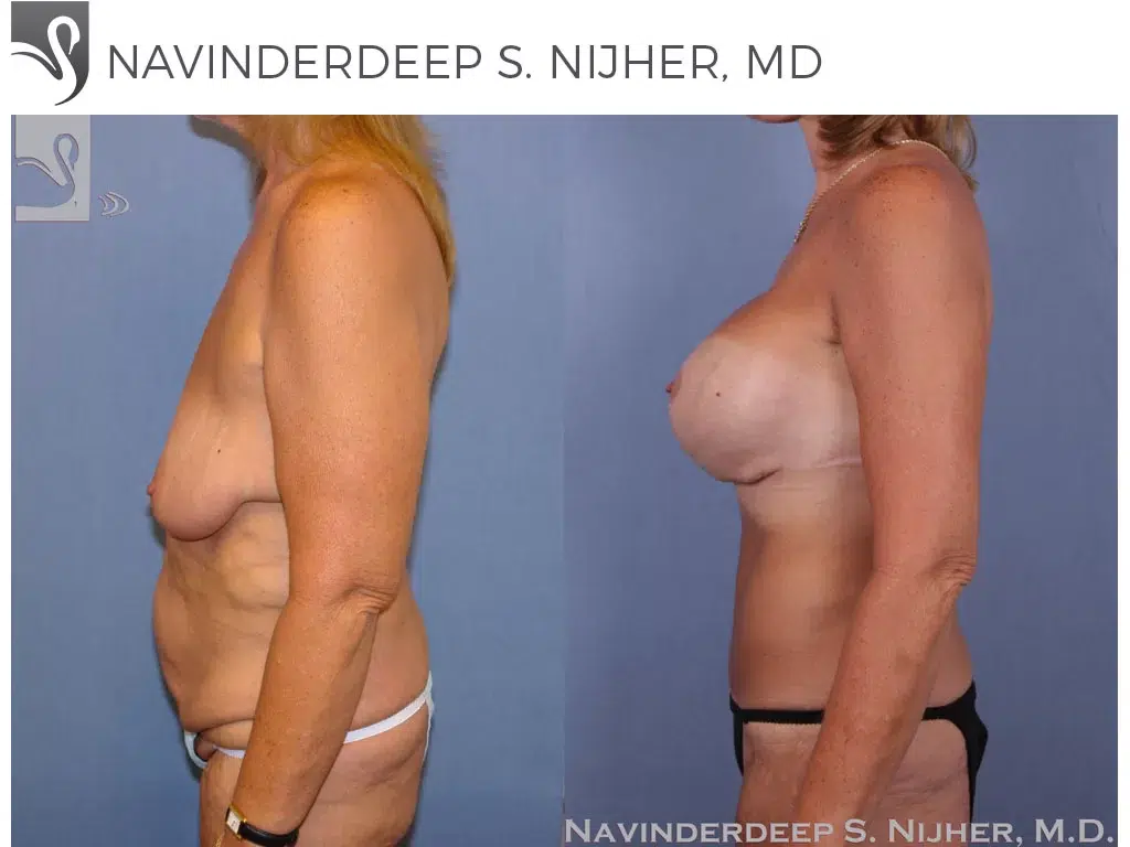Before and After Image: Mommy Makeover Case #8797 - left-side