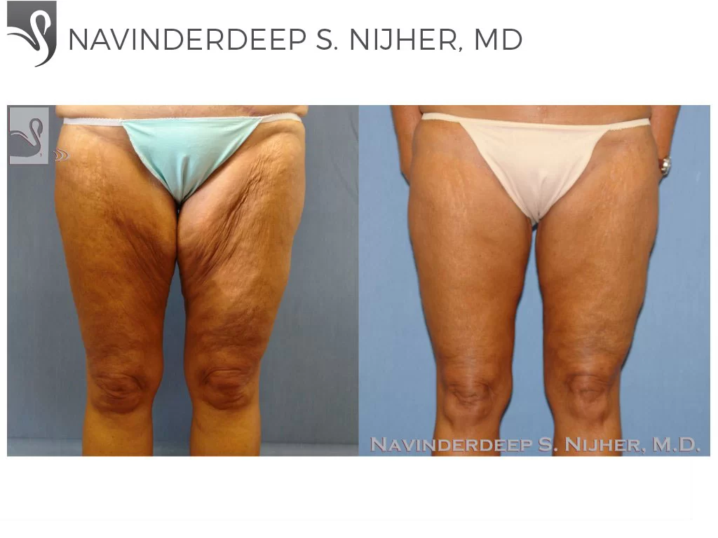Before and After Image: Thigh Lift Case #8797