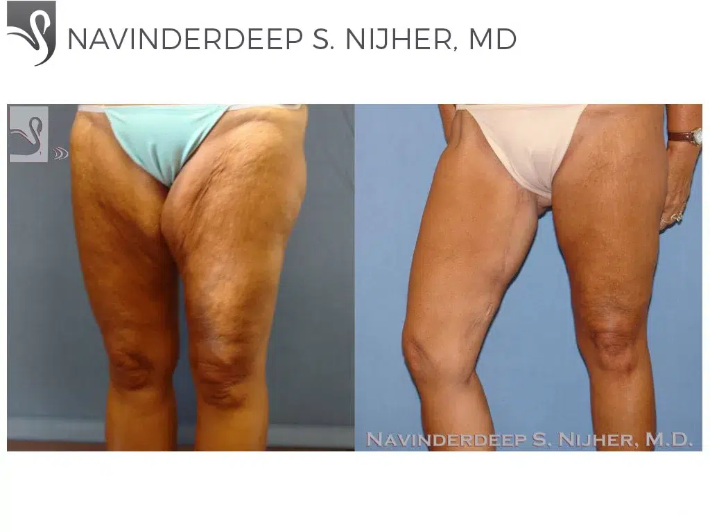 Before and After Image: Thigh Lift Case #8797 - left-front-oblique