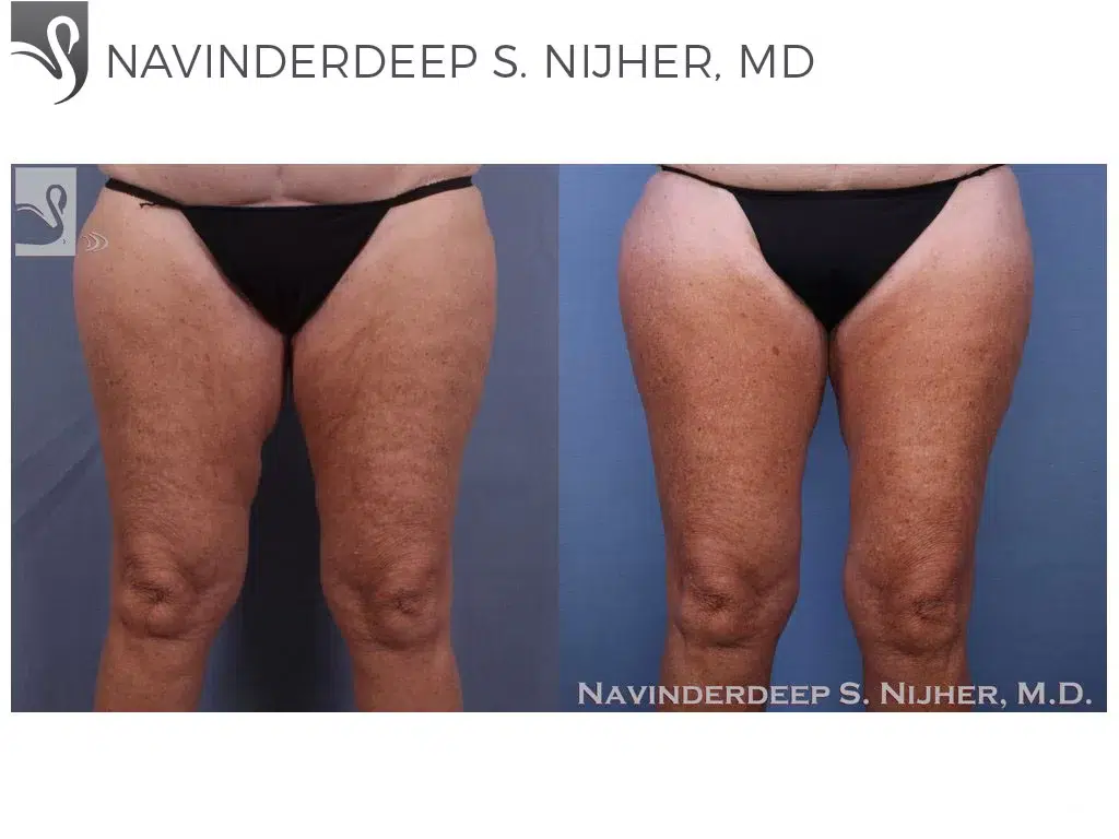 Before and After Image: Thigh Lift Case #8932 - front