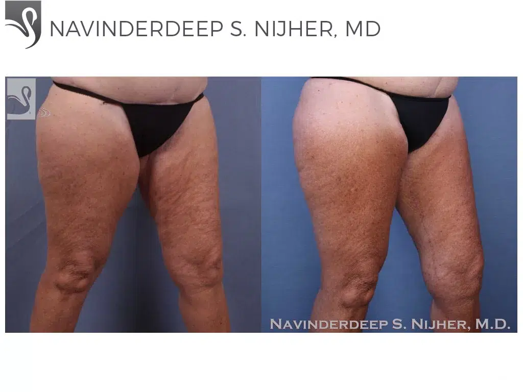 Before and After Image: Thigh Lift Case #8932 - right-front-oblique
