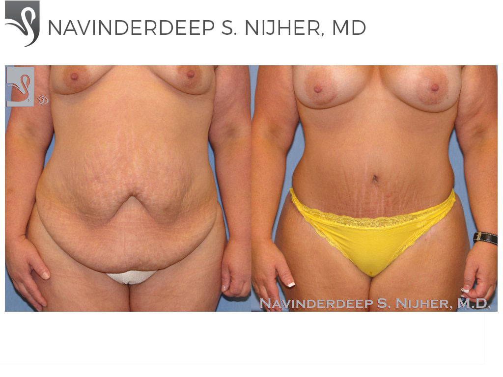 Before and After Image: Abdominoplasty (Tummy Tuck) Case #8987 - front