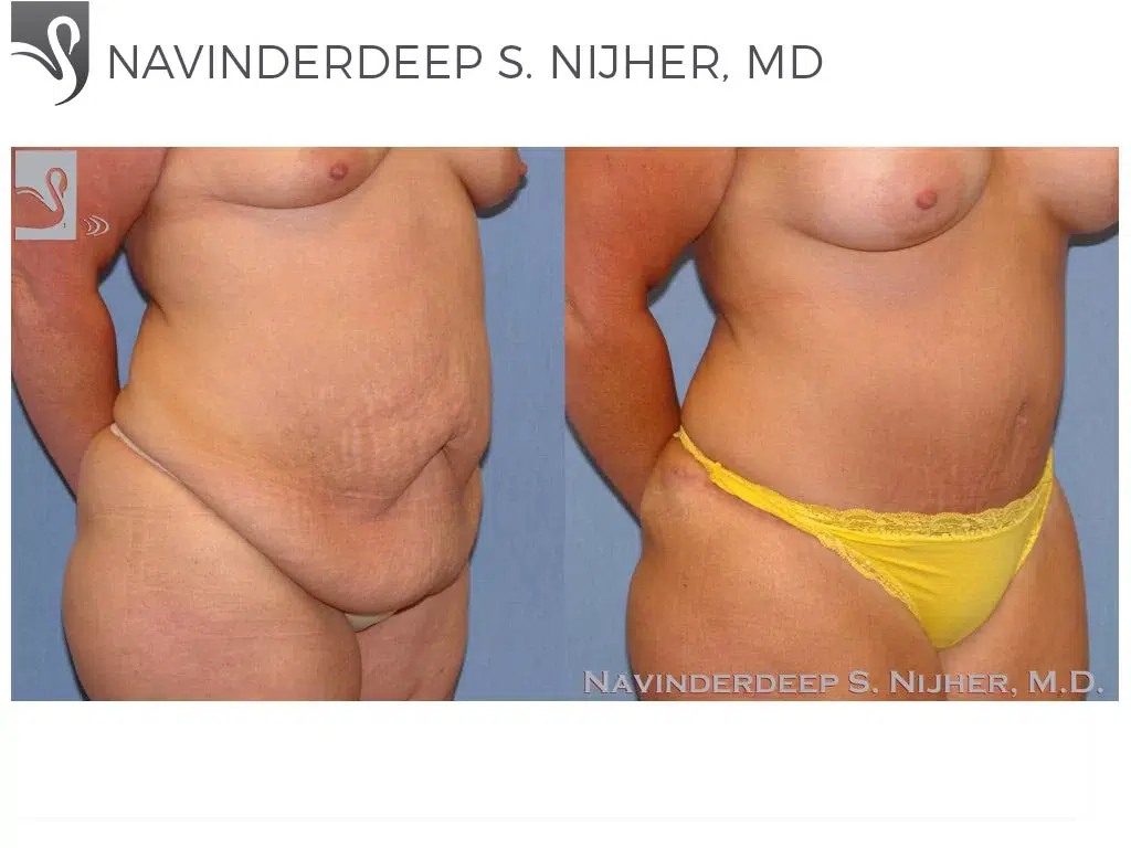 Before and After Image: Abdominoplasty (Tummy Tuck) Case #8987 - right-front-oblique