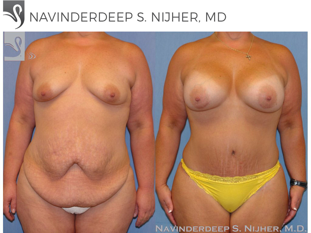 Before and After Image: Mommy Makeover Case #8987 - front