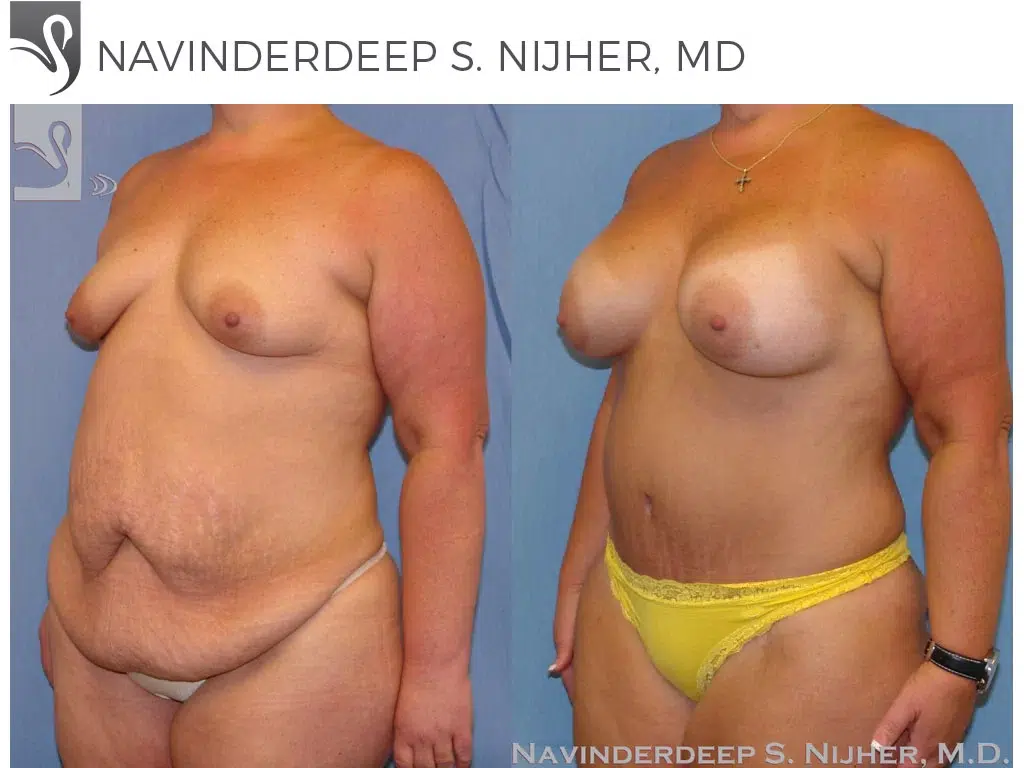 Before and After Image: Mommy Makeover Case #8987 - left-front-oblique