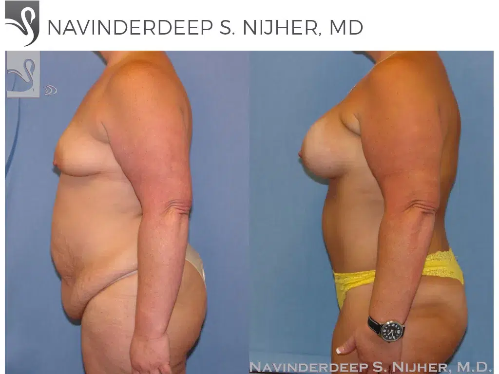 Before and After Image: Mommy Makeover Case #8987 - left-side