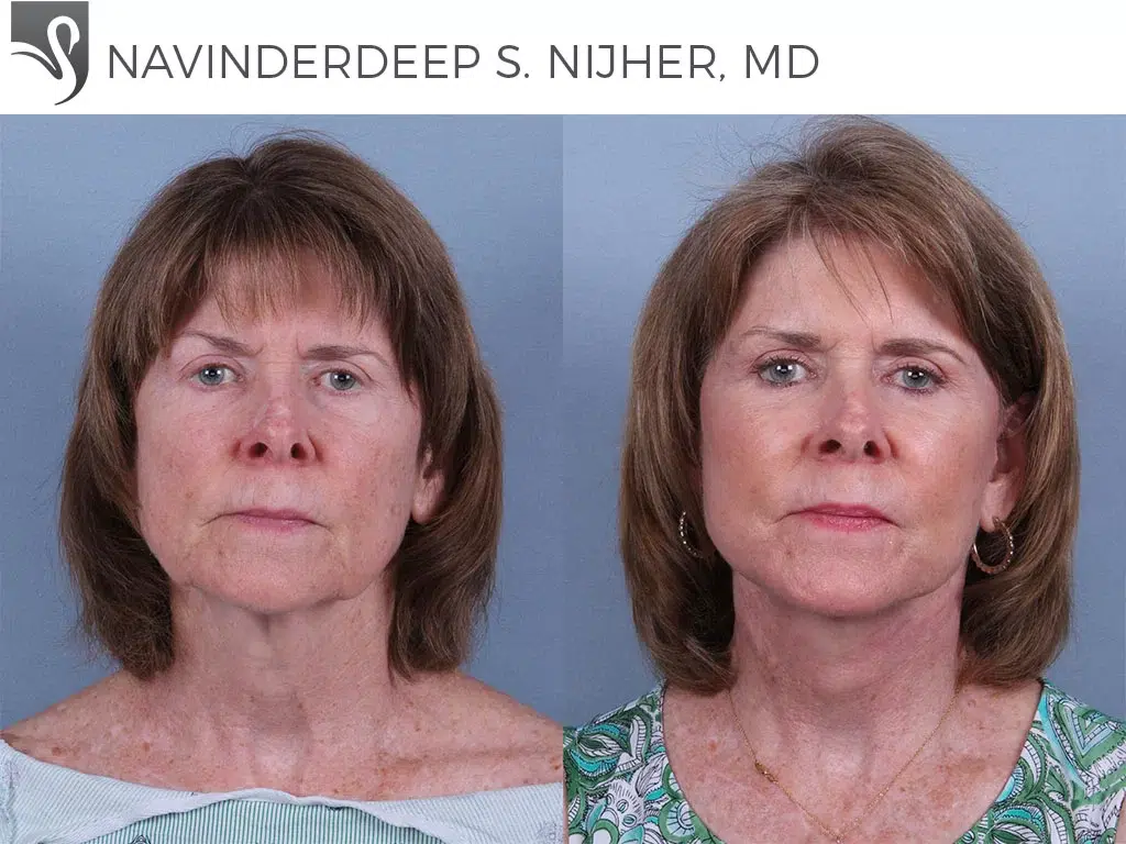 Before and After Image: Face Lift Case #9023 - front