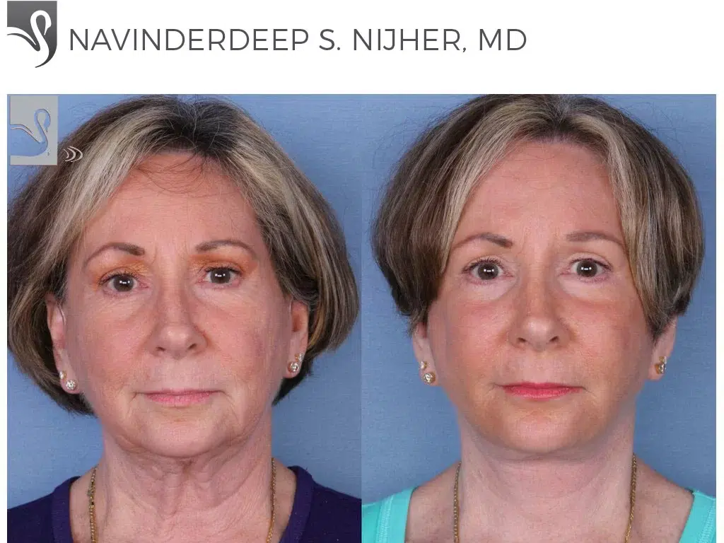 Before and After Image: Face Lift Case #9217 - front
