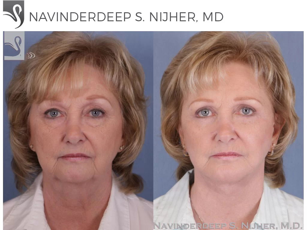 Before and After Image: Facial Implants Case #985