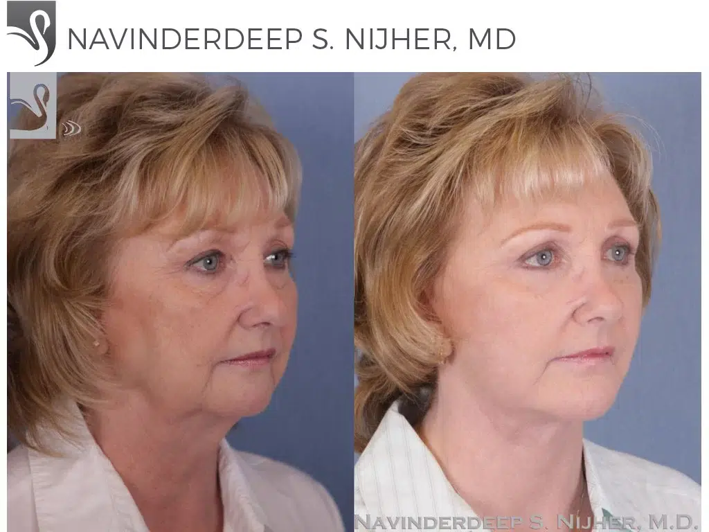 Before and After Image: Facial Implants Case #985 - right-front-oblique
