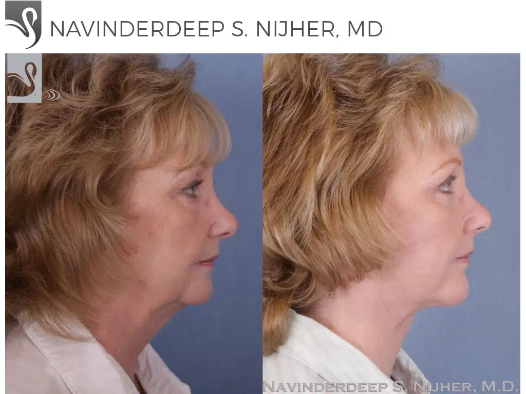 Before and After Image: Facial Implants Case #985 - right-side