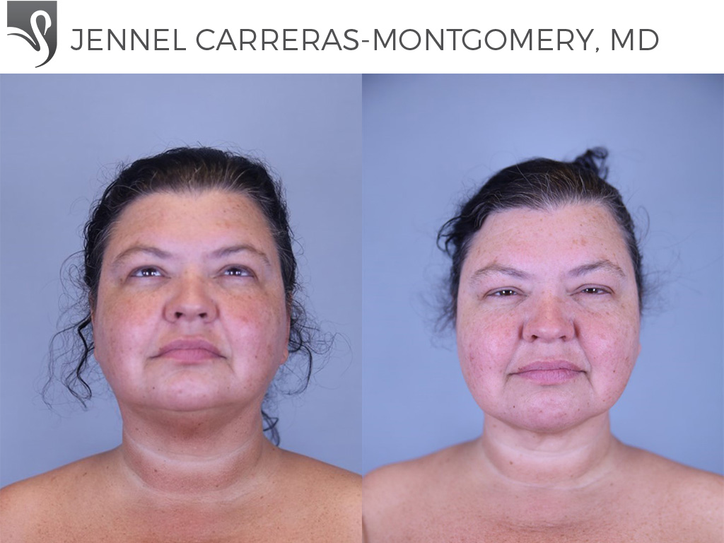 Before and After Image: Liposuction Case #81324
