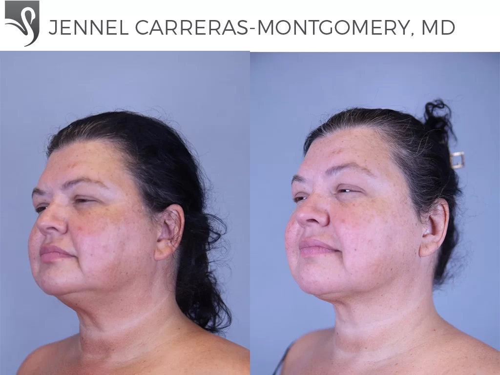 Before and After Image: Liposuction Case #81324 - left-front-oblique