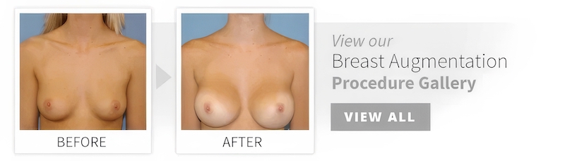 before after breast augmentation desktopEdit
