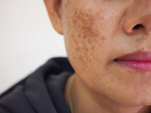 Close up of a patient's face with melasma spots on their cheeks, in need of VI Peel.