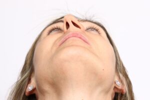 Close up of a woman looking straight up to show the severity of her deviated septum, in need of rhinoplasty.
