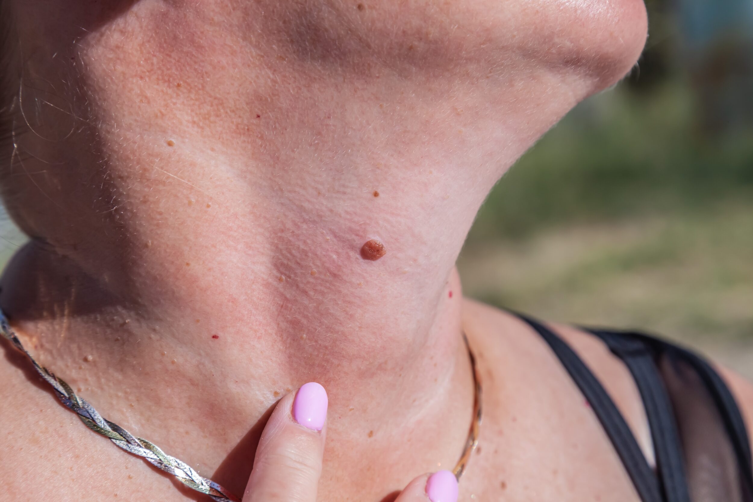 Woman,Examing,Her,Abnormal,Mole.,Dermatology,Procedure.,Doctor,Checking,Patient