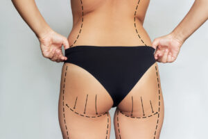 Close up of a woman's behind with diagrams and arrows drawn to illustrate her planned Brazilian Butt Lift.