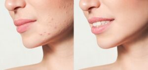 Before and after of a woman's jaw after receiving micro-needling treatment for acne scarring.