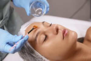 Close up of a woman receiving a VI chemical peel to renew and refresh her skin.