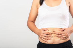 Close-up of a woman pushing up the loose skin on her abdomen, in need of an abdominoplasty.