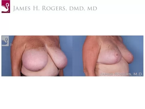 Female Breast Reduction Case #56225 (Image 2)