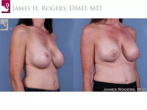 Breast Revisions Case #61009 (Image 2)