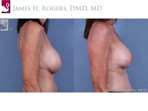 Breast Revisions Case #61009 (Image 3)