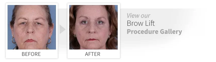 View our Brow Lift Procedure Gallery